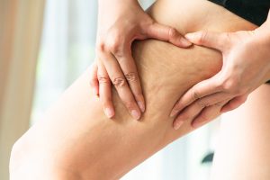 É possível prevenir a celulite? | Fisiointegral em Gaia