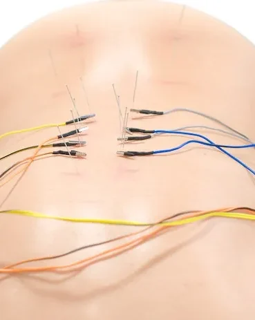 Acupunctura Acupunctura