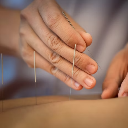 acunpuntura
