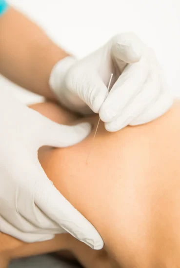 punção seca punção seca